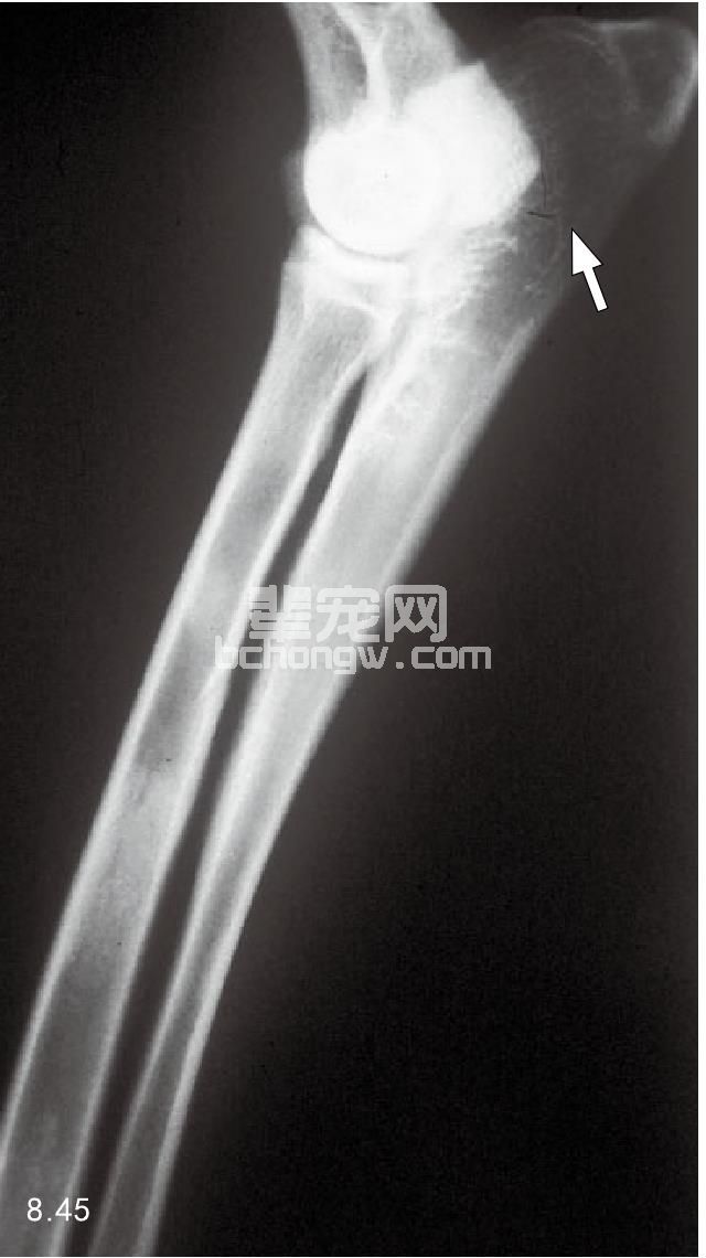 滑液细胞肉瘤