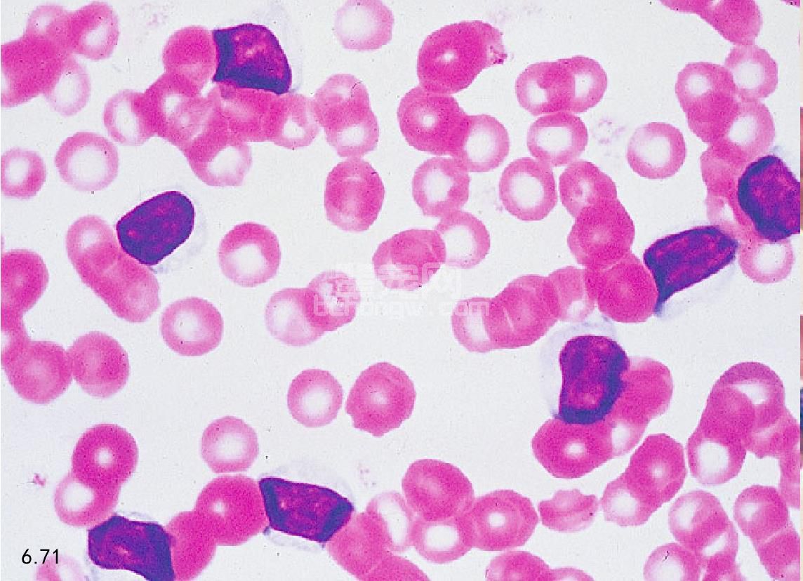 光镜下慢性淋巴细胞白血病(CLL)血液涂片照片摄影图片_ID:318175084-Veer图库