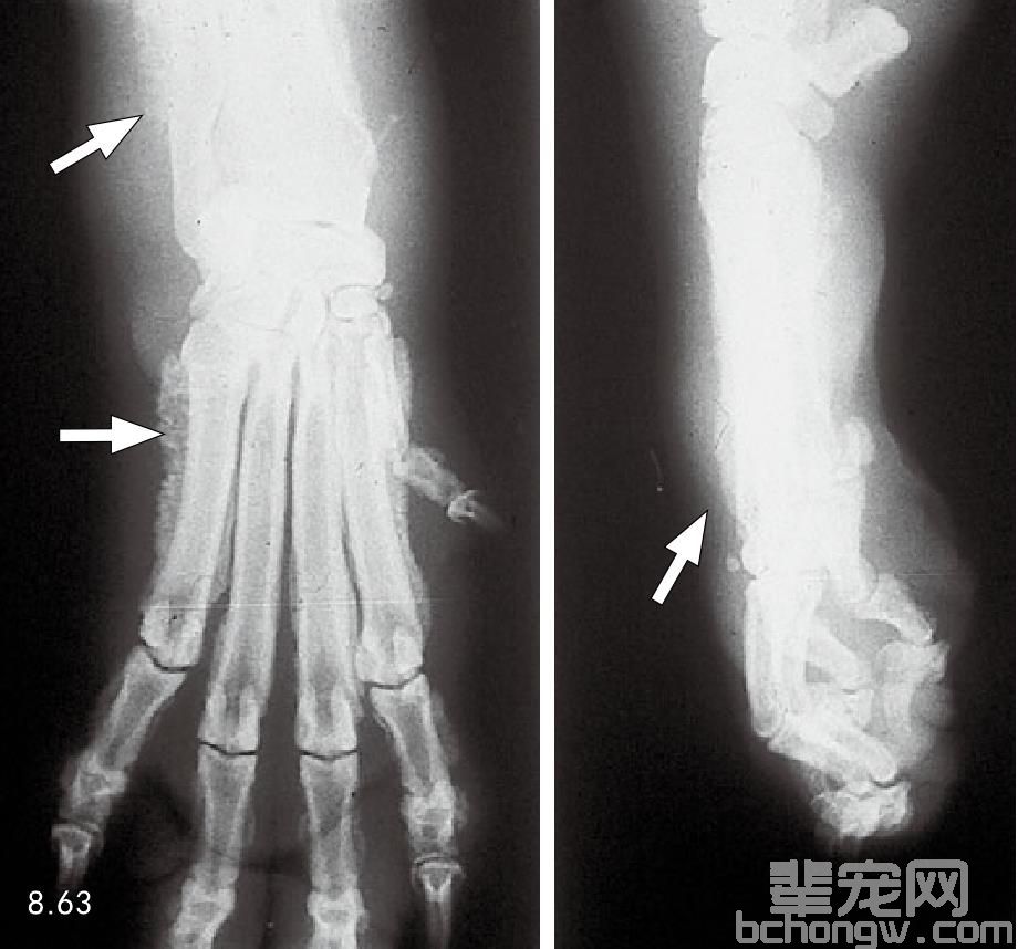 继发性肥大性骨病