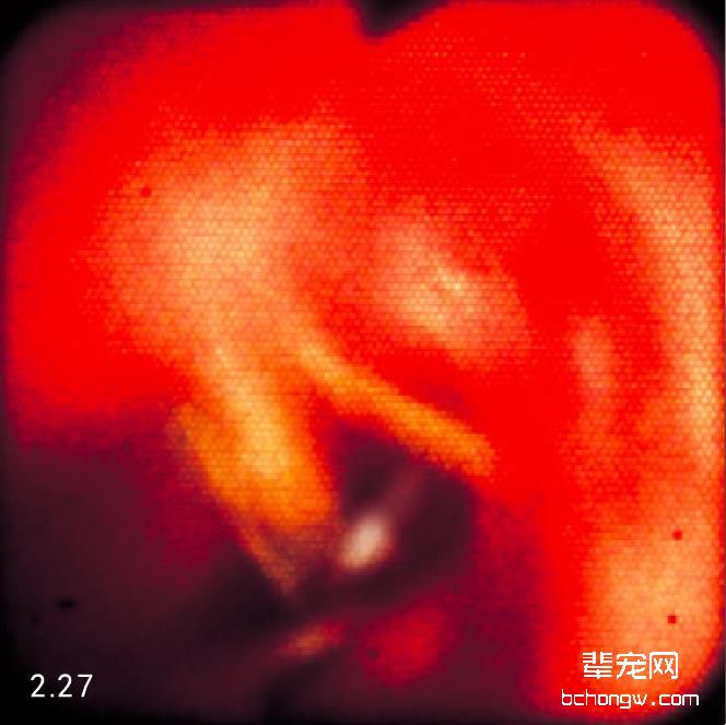吸入气管／支气管异物