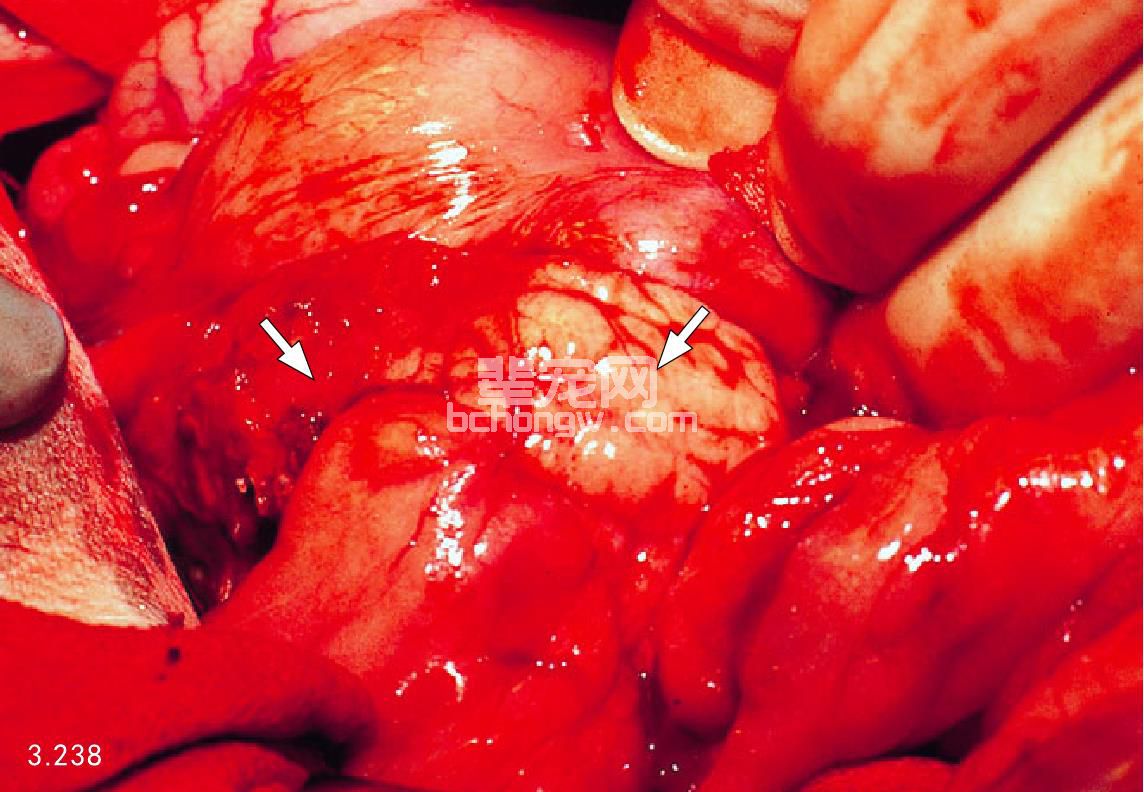 急性胰腺炎
