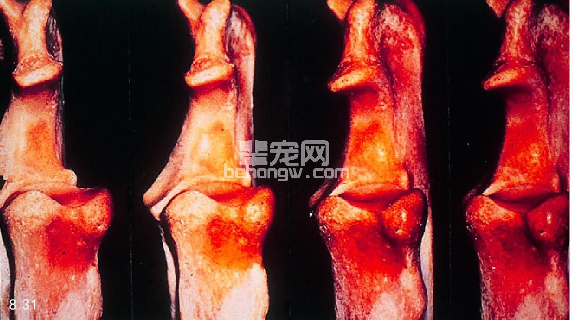 肘关节发育异常