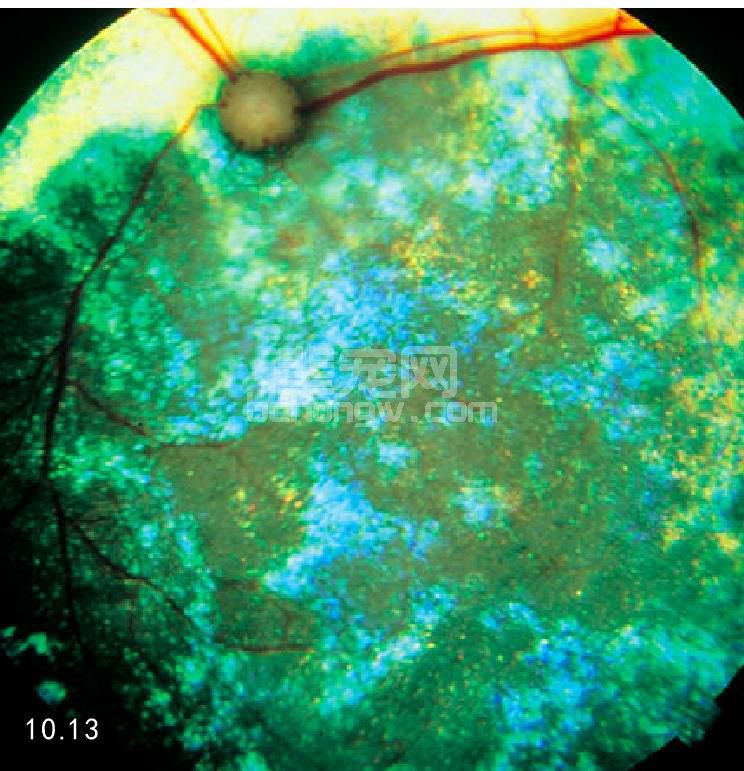 组织胞浆菌病