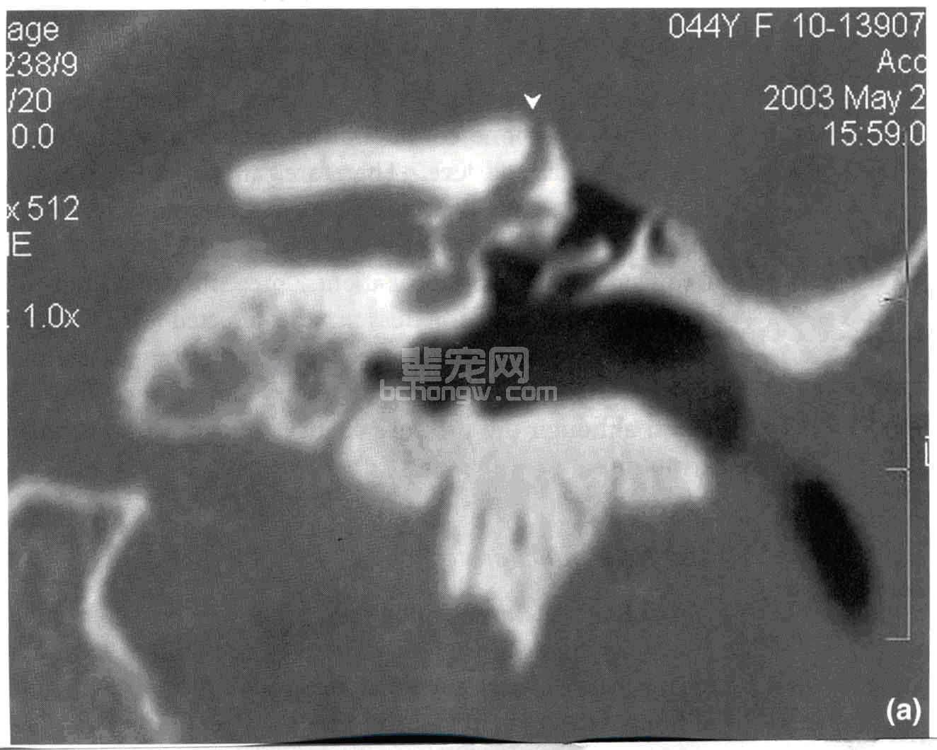 前庭耳蜗神经疾病