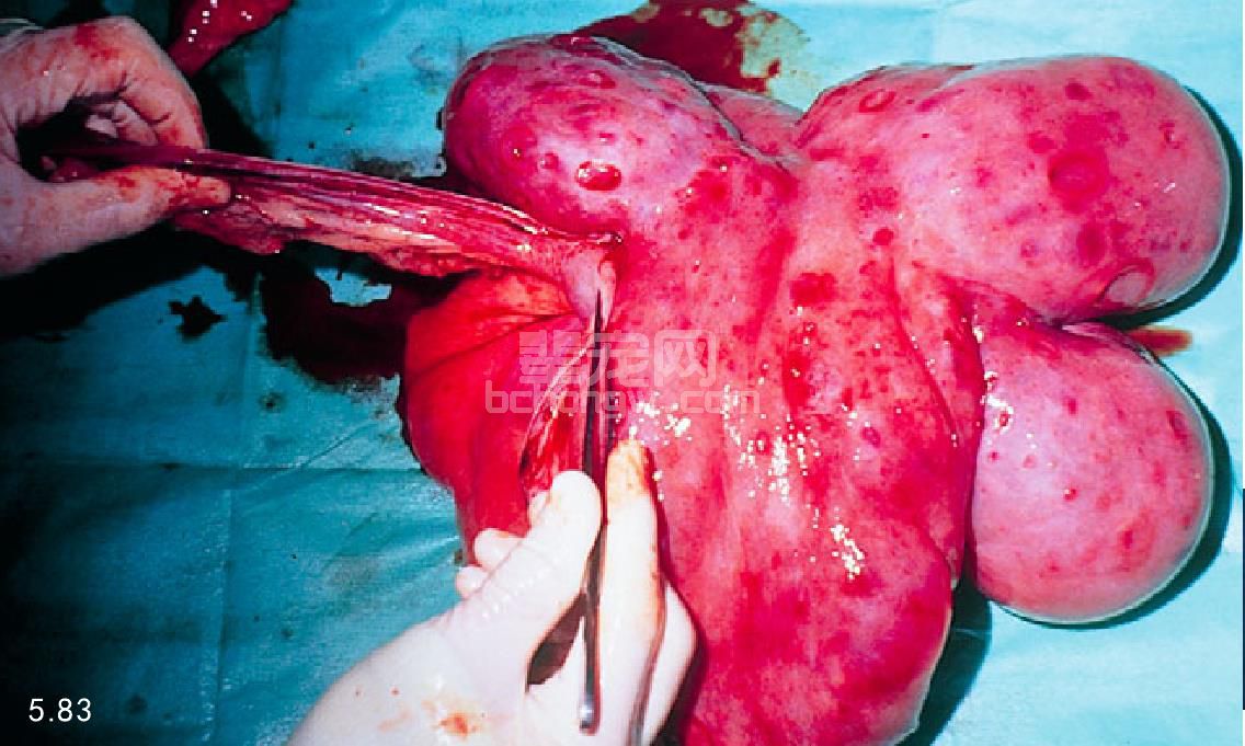 生殖道管腔肿瘤