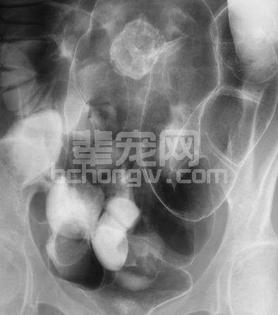 慢性前列腺炎