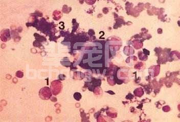 纯红细胞再生障碍