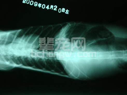 先天性免疫缺陷