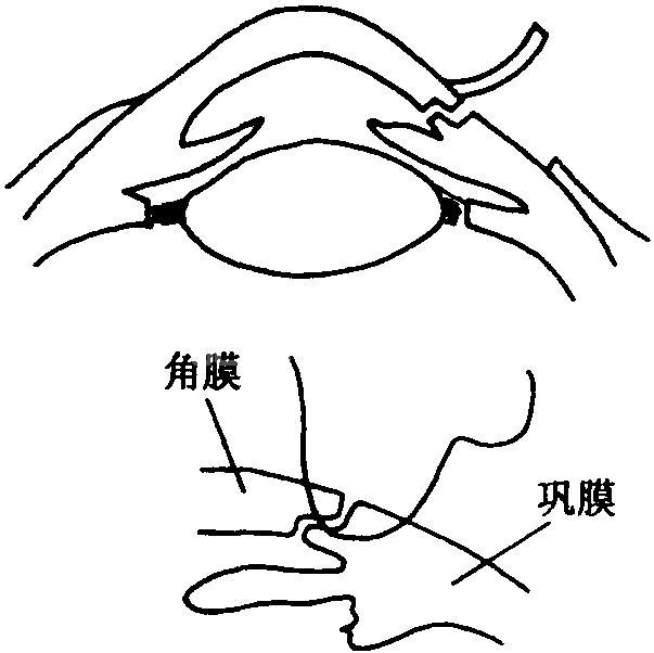 (三) 眼球异常