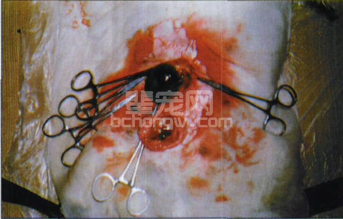 图3-10 脐箝顿性疝手术中