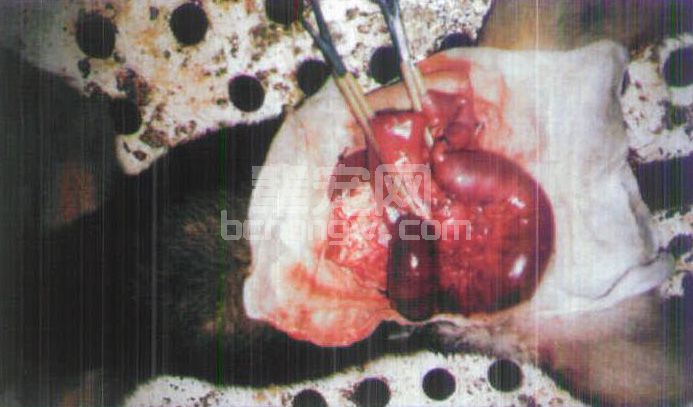 图3-11 肠套叠手术