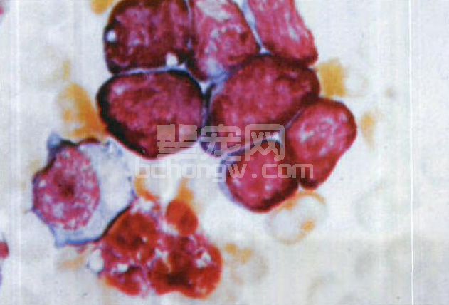 图4-13 淋巴肉瘤骨髓像