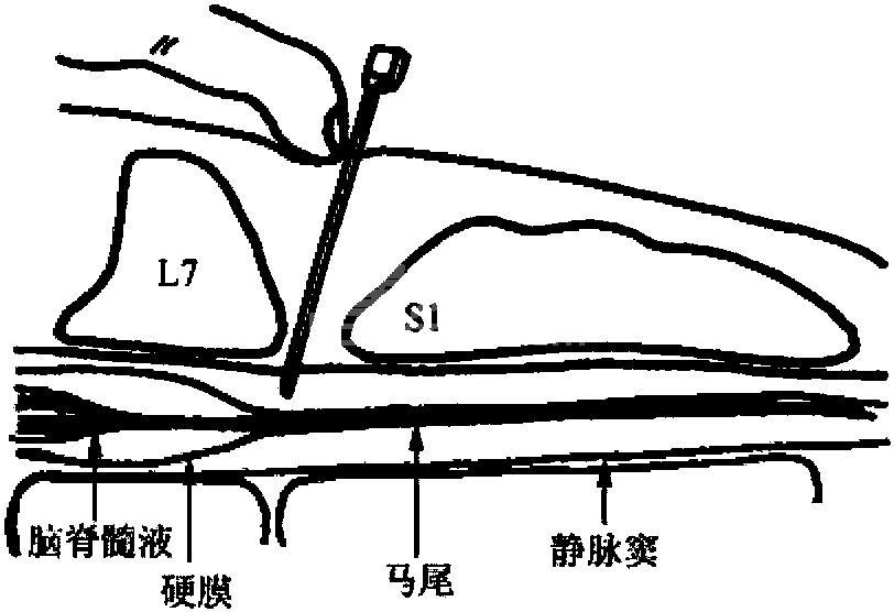 (一) 局部麻醉