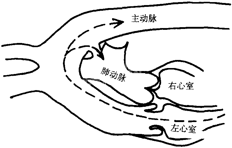 (十六) 动脉导管未闭手术