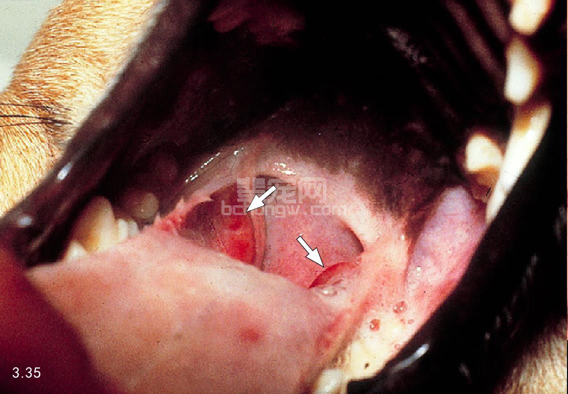 4. 扁桃腺炎