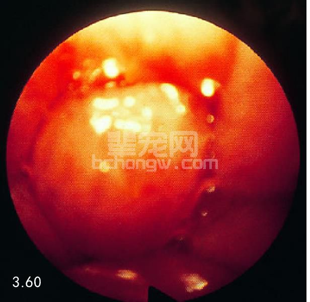 4. 食管腔内性或壁性阻塞