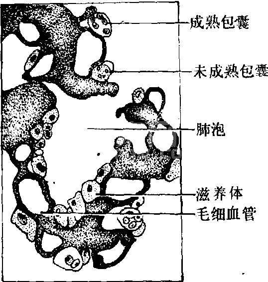 卡氏肺孢子虫病