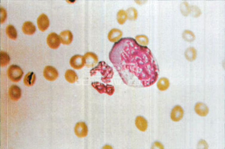 图4-5 犬传染性肝炎单核细胞像(1个嗜中性白细胞和1个浓染的单核细胞样细胞，血小板消失)