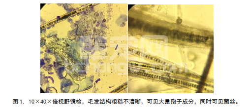 一例猫小孢子菌感染的病例报告