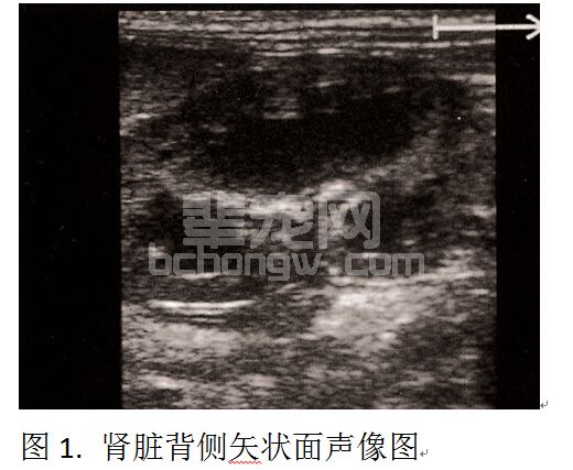 肾脏超声检查技术