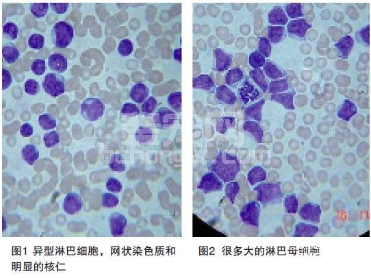一例犬急性淋巴母细胞白血病的病例报告
