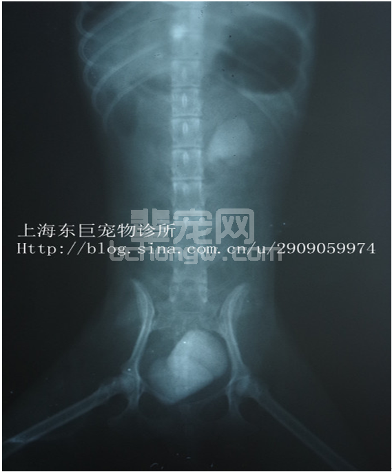 肾结石手术新方法