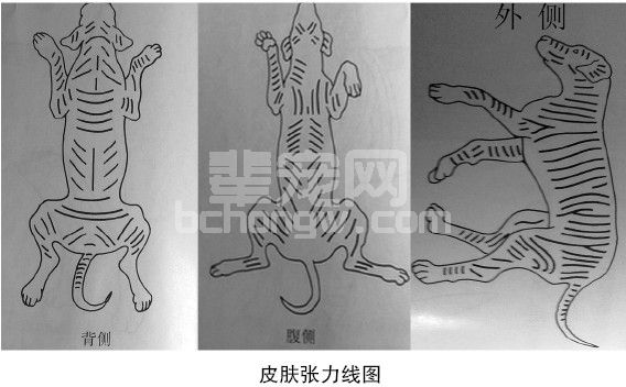 一例皮瓣技术在临床上的应用
