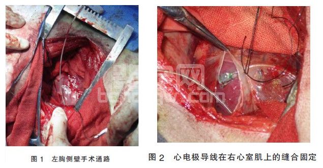 两种开胸术法建立犬右心衰模型的对比