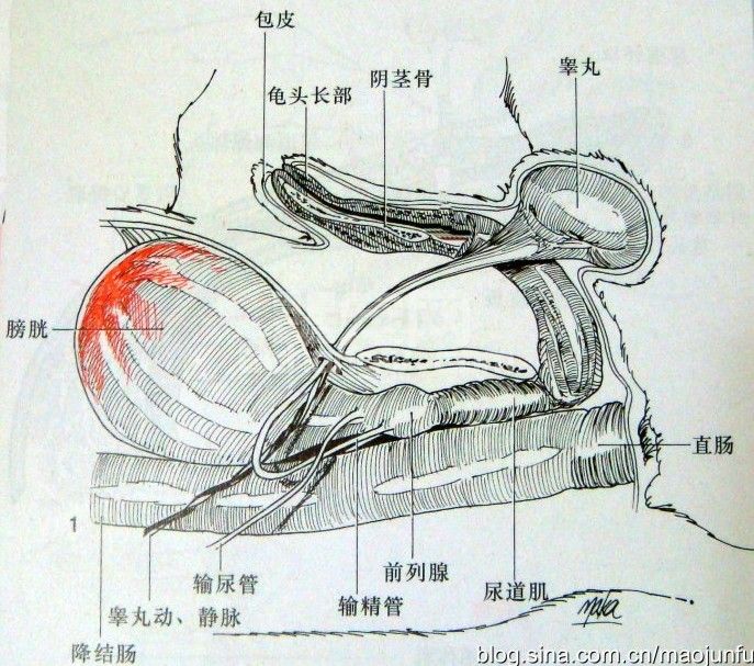 会阴疝膀胱腹腔固定