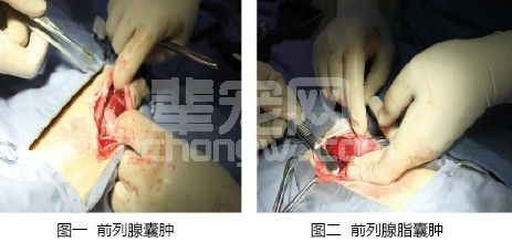 一例耻骨骨折导致尿道闭锁病例分析
