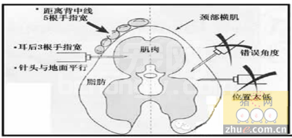 养殖户们给猪打针的部位正确吗？