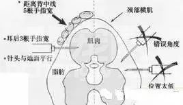 老兽医指导你如何规范给猪打针！