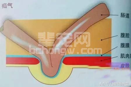 猪脐疝不用怕，这里有一种任何人都可以操作的胶布固定方法！